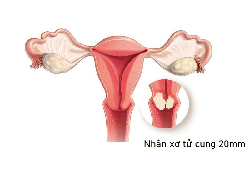Nhân xơ tử cung 20mm có nguy hiểm không? Cách chữa như thế nào?