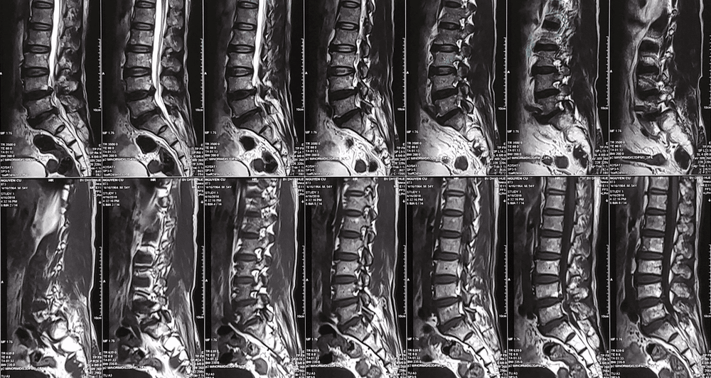 Kết quả chụp cộng hưởng từ cột sống thắt lưng