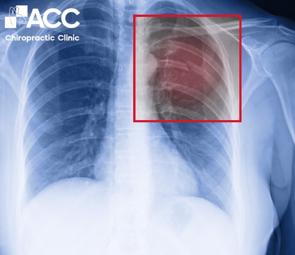 đau bả vai phải sau lưng