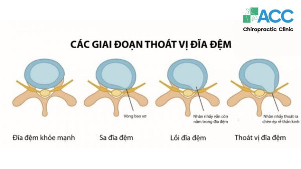 thoát vị đĩa đệm là sao