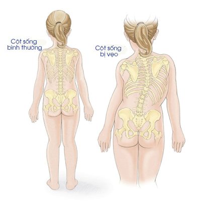 Ngồi học đúng tư thế, tránh cong vẹo cột sống – Trường THCS Ngoại ngữ – Trường Đại học Ngoại ngữ – ĐHQGHN