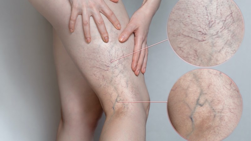 Hình ảnh cấp độ 2, động mạch nổi rõ, vạch đen xuất hiện