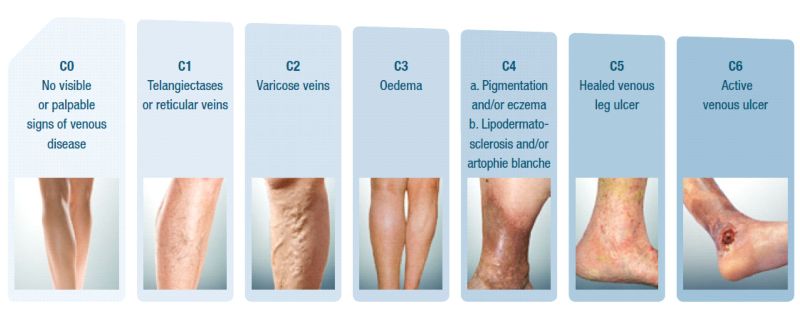 Hình ảnh các cấp độ suy giãn tĩnh mạch