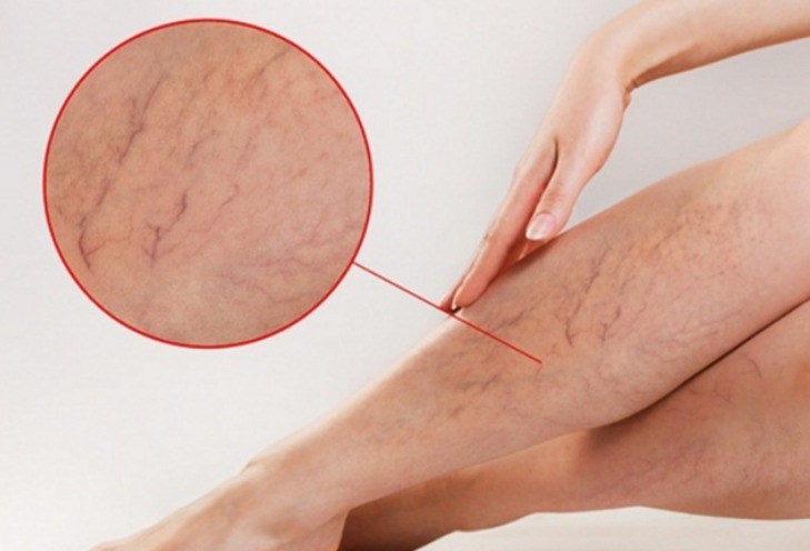 Hình ảnh suy giãn cấp độ 1