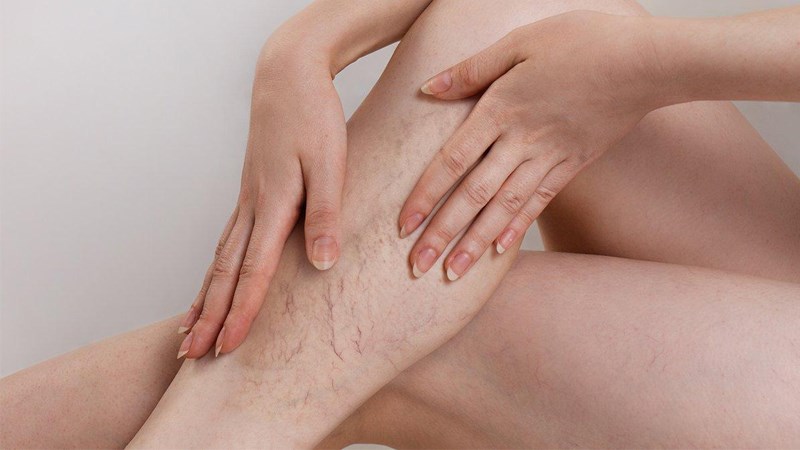 Các cấp độ suy giãn tĩnh mạch từ mức độ nhẹ tới nặng