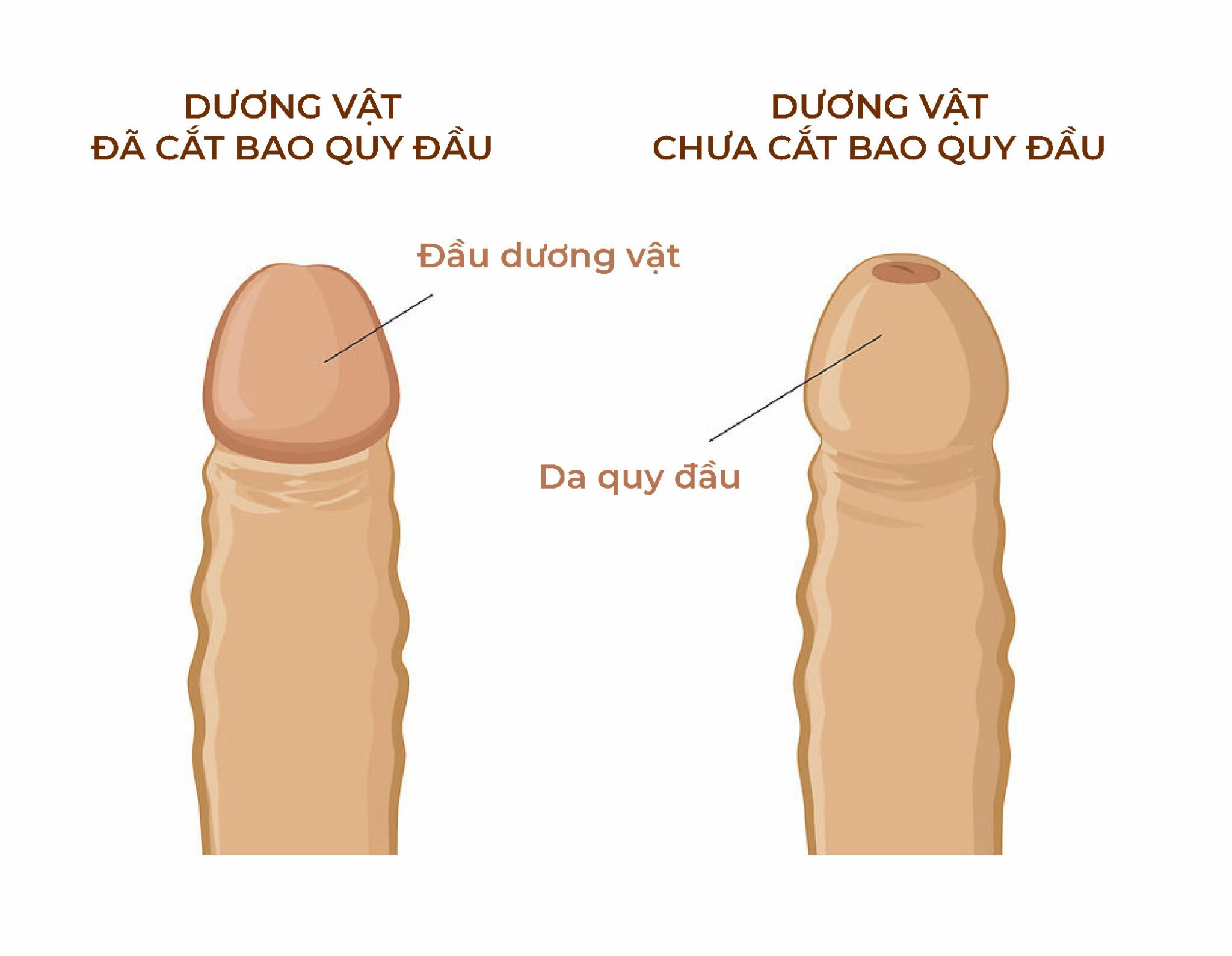 Hẹp bao quy đầu