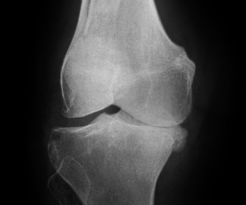 Thoái hóa khớp gối có mấy độ?