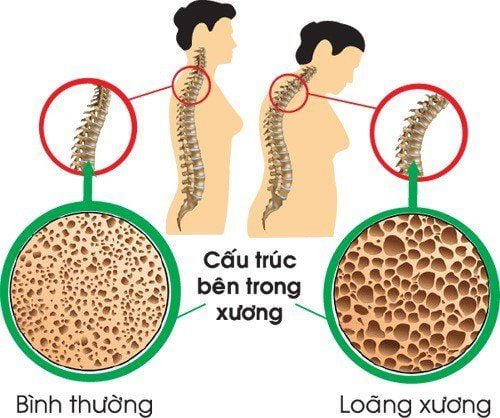 Để chống cong vẹo cột sống cần phải làm gì?