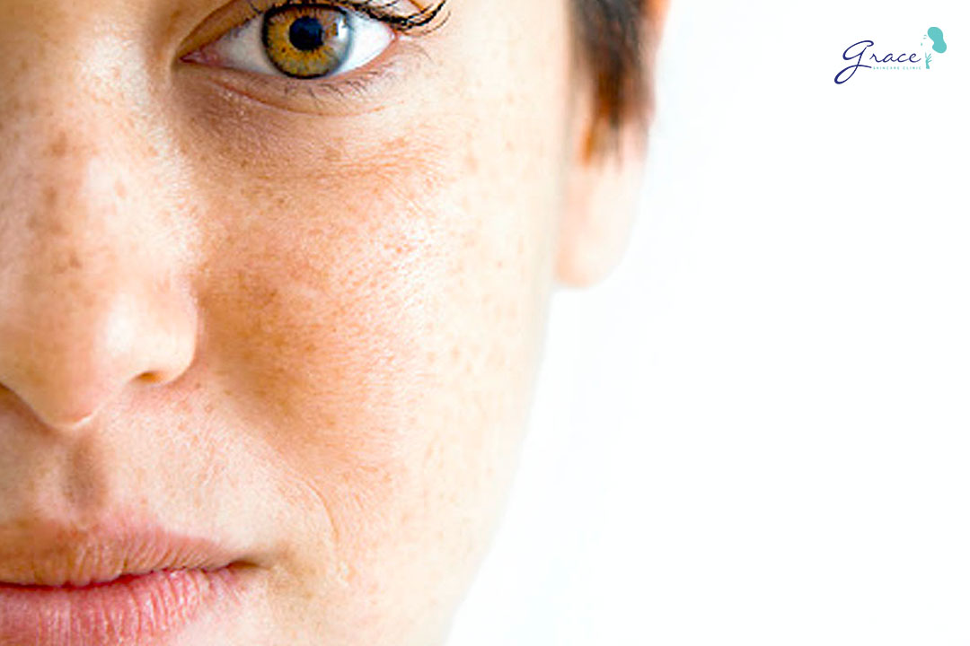 Tìm hiểu trị đốm nâu bằng laser và nguyên nhân xuất hiện đốm nâu?