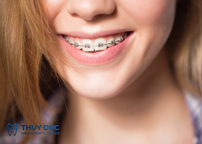 4. Niềng răng thẩm mỹ 1