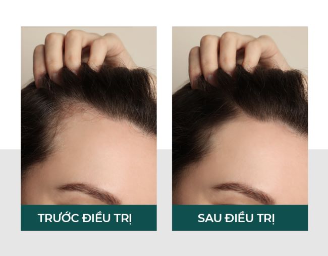 Derma Hair Loss lấy lại mái tóc tuổi thanh xuân