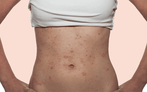 Đeo đại nịt bụng sau sinh quá nhiều có thể bị dị ứng, nổi mẩn đỏ tại những vùng da tiếp xúc trực tiếp với đai