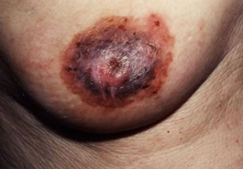 Bệnh Paget là một trong các bệnh gây đau núm vú cho người mắc