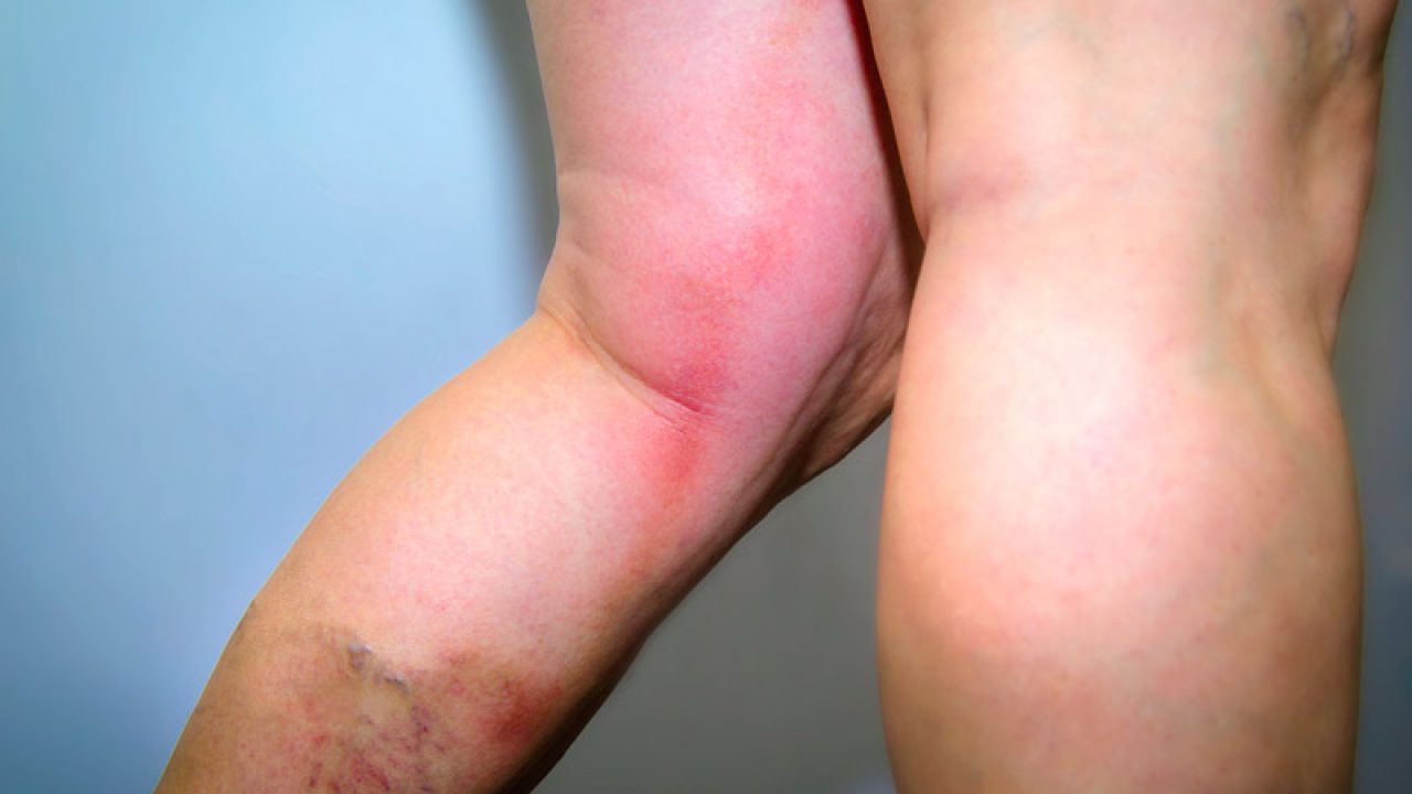 ️ Hội chứng loạn dưỡng thần kinh giao cảm phản xạ là gì?