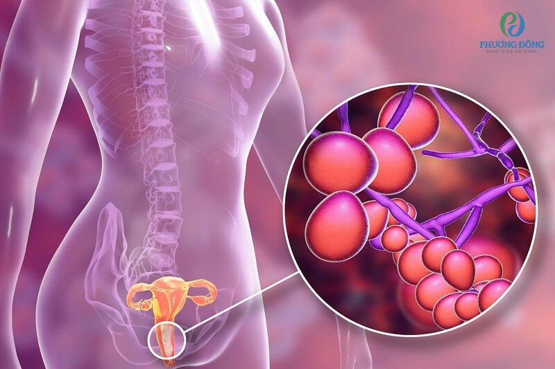 Viêm âm đạo cũng xuất hiện tình trạng ra dịch màu hồng