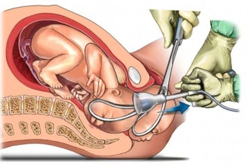 Hỗ trợ sinh bằng kỹ thuật đặt Forceps: Những điều cần biết