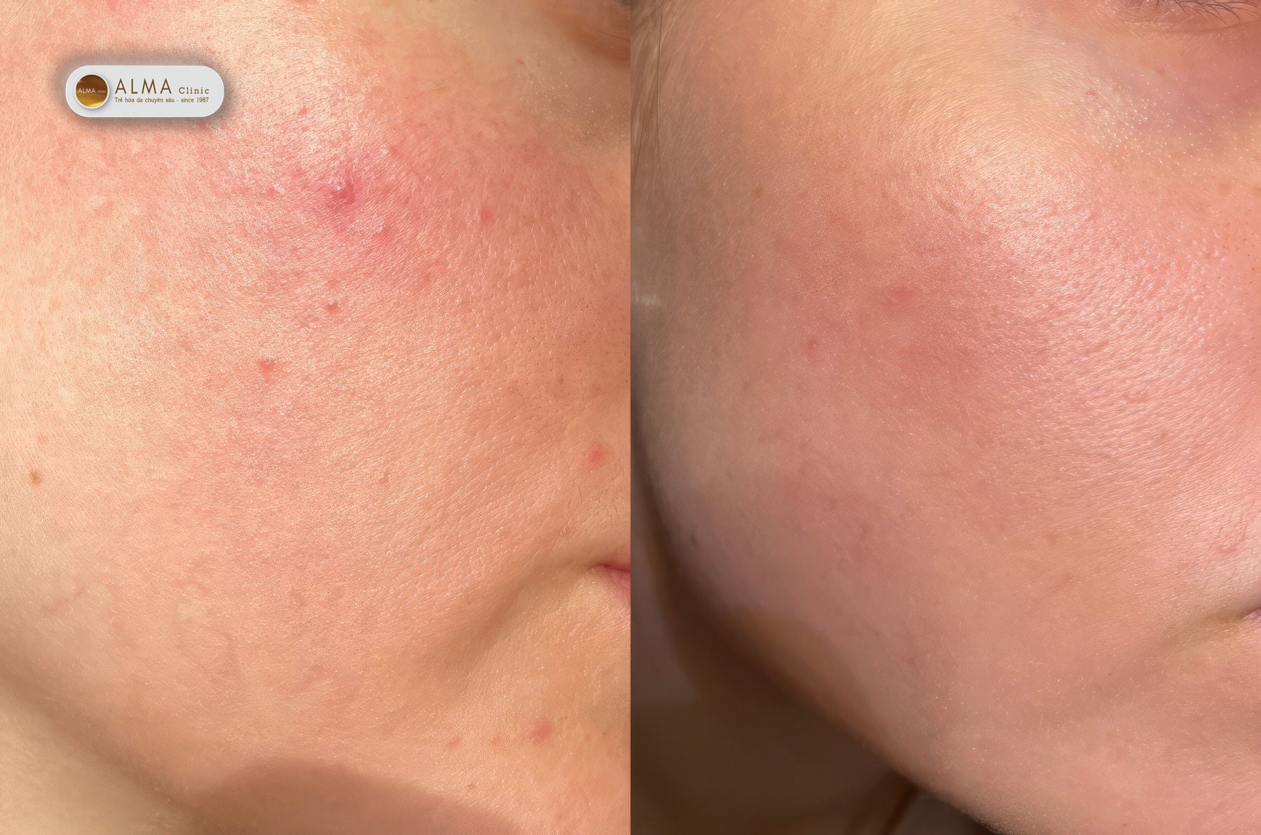 Vậy có phương pháp trị nám cấp tốc tại nhà nào vừa nhanh, vừa an toàn không?