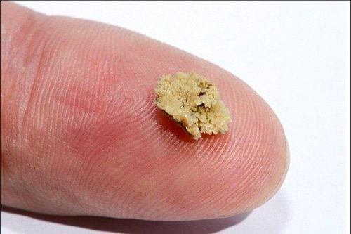 Sỏi thận 6 - 7mm không phải quá to, nhưng cũng không còn nhỏ, có thể uống thuốc hoặc sử dụng các phương pháp tán sỏi