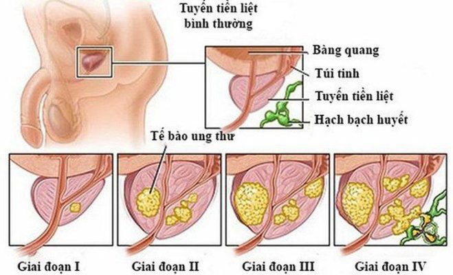 Xuất tinh ra máu: Những điều cần biết
