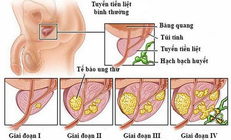 Ung thư tuyến tiền liệt gây xuất tinh ra máu.