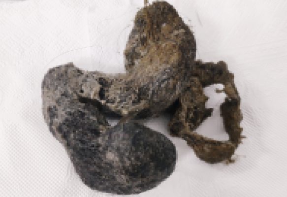 Ám ảnh lọn tóc khổng lồ quấn chặt dạ dày bé gái 4 tuổi vì hội chứng kỳ lạ