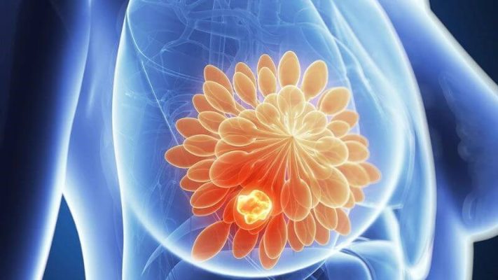 Tổng quan hình ảnh ung thư vú chị em cần biết