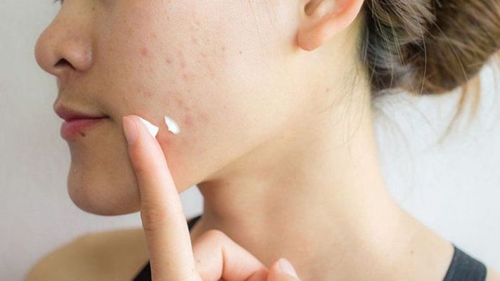 Azelaic acid có tác dụng gì?