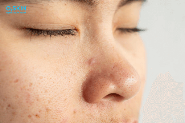 TOP 12 cách trị mụn cám hiệu quả, có thể áp dụng tại nhà