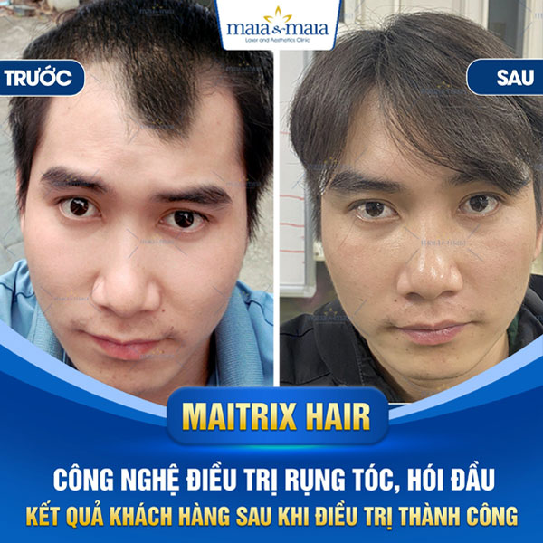 khách hàng điều trị hói đầu thành công