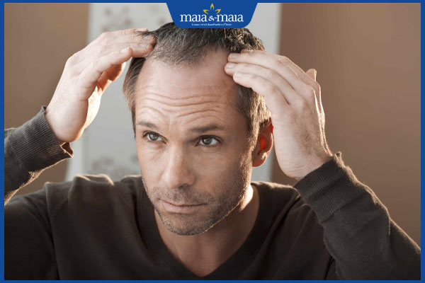 Tướng đàn ông đầu hói như thế nào? Cách chữa hói hiệu quả