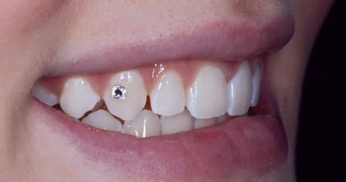 💎 Có nên đính đá vào răng không? Có ảnh hưởng gì không?