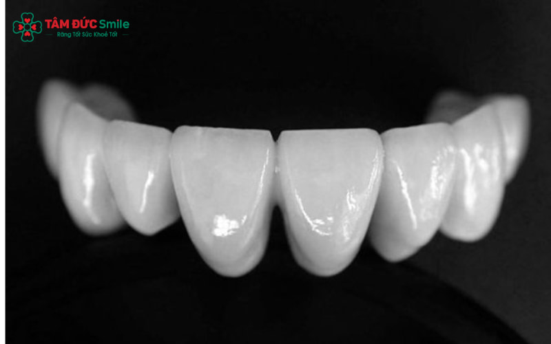 Quy trình bọc răng sứ Cercon tại Nha khoa Tâm Đức Smile được thực hiện chuẩn quốc tế