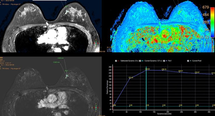 MRI vú, một thiết bị chẩn đoán vú sử dụng Chụp cộng hưởng từ (MRI).