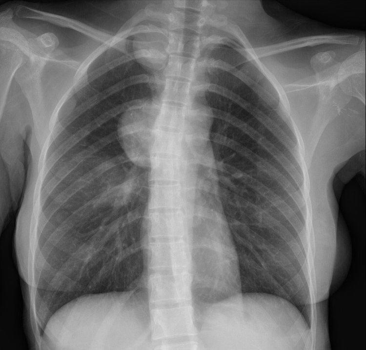 Chụp X quang có thể chẩn đoán bệnh u trung thất