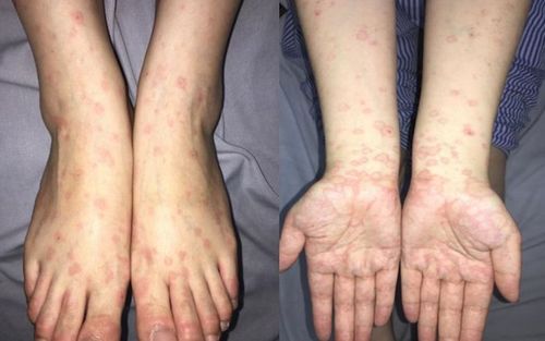 Phòng ngừa herpes sinh dục bùng phát là rất quan trọng