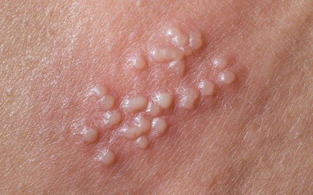 Herpes sinh dục: Hình ảnh, Triệu chứng và Điều trị