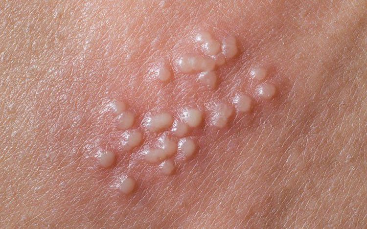 Hình ảnh herpes sinh dục
