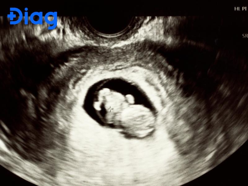 hình ảnh siêu âm con gái