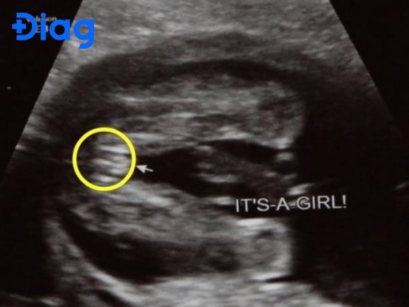 hình ảnh siêu âm con gái