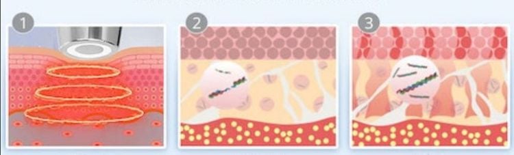 Nâng cơ mặt bằng sóng RF có tốt không
