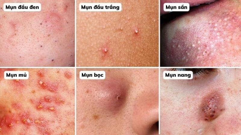 Không nặn mụn có tự hết không? 4