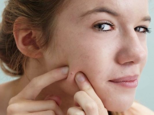 Không nặn mụn có tự hết không?