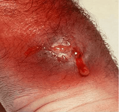 Làm Gì Khi Vết Thương Chảy Nước Vàng?