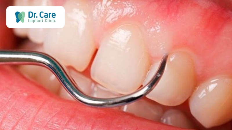 Tốc độ chuyển đổi và khả năng hồi phục của nướu