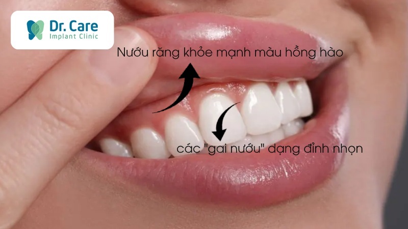 Nướu răng khỏe mạnh có những đặc điểm gì?