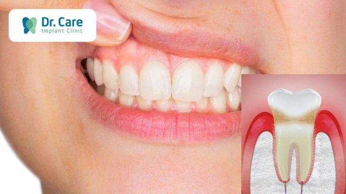 Nướu răng là gì? Cấu tạo, chức năng và các bệnh thường gặp