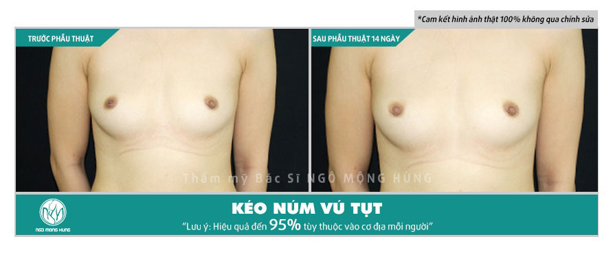 Hình ảnh núm vú bị tụt vào trong