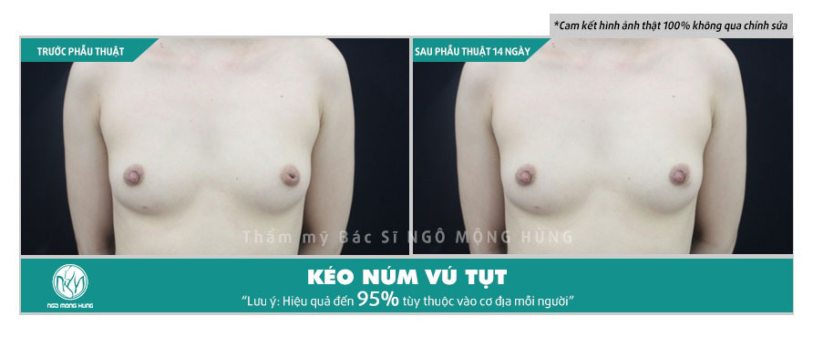 Hình ảnh núm vú bị tụt vào trong