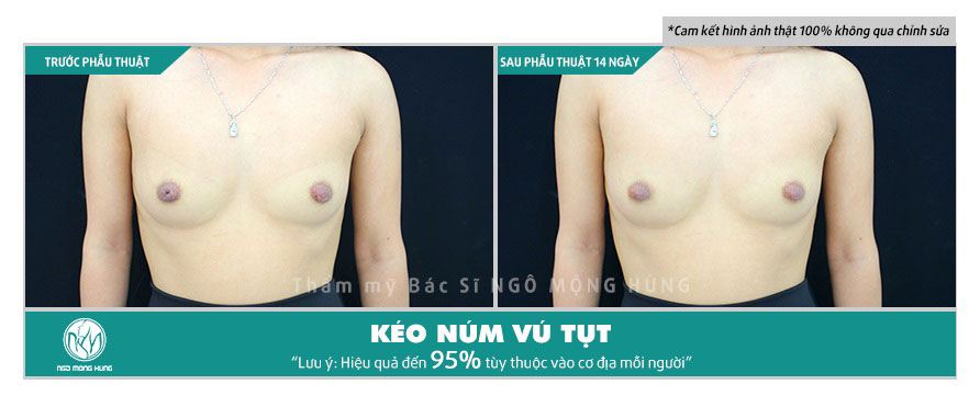 Hình ảnh núm vú bị tụt vào trong