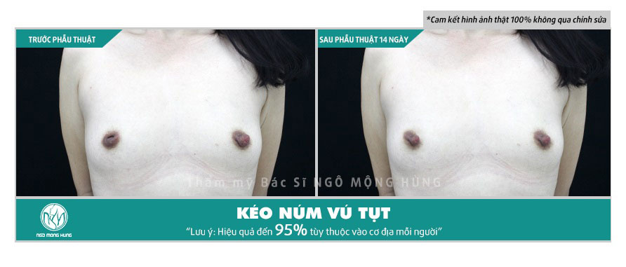 Hình ảnh núm vú bị tụt vào trong sau khi chữa trị như thế nào?